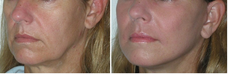 Фото до микротокового лифтинга кожи лица и после