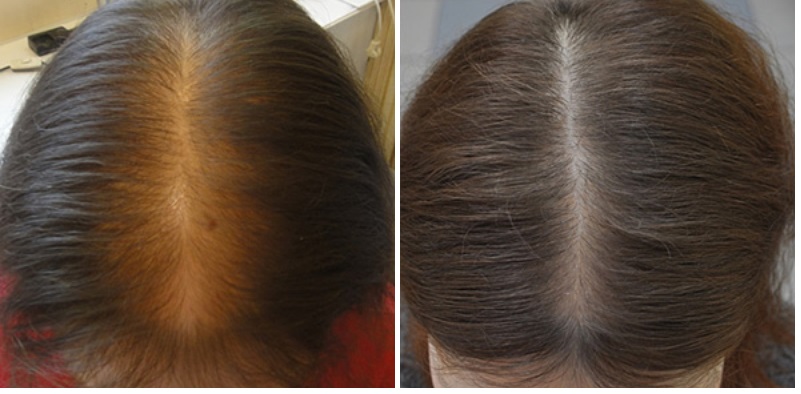 Фото до восстановления сывороткой волос и после