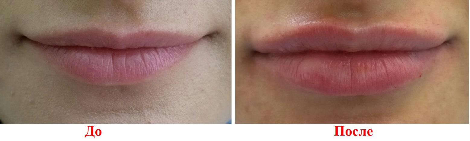 Фото до контурной пластики губ и после