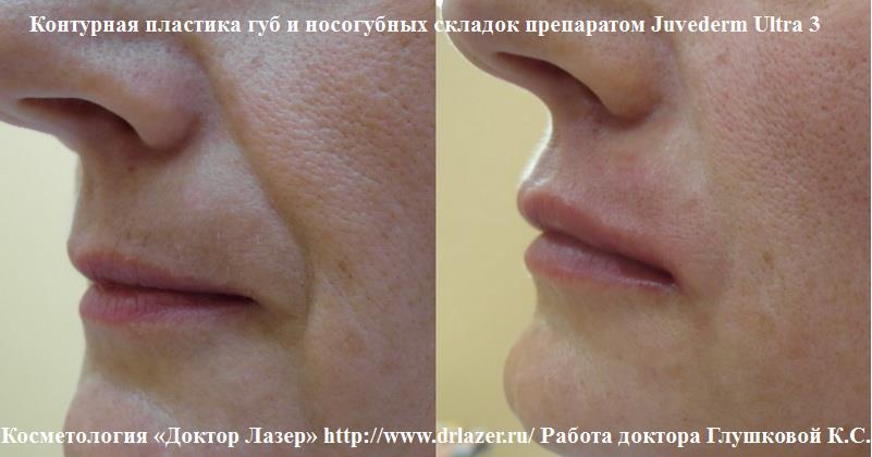 Пример лечения: Контурная пластика губ и носогубных складок препаратом Juvederm Ultra 3