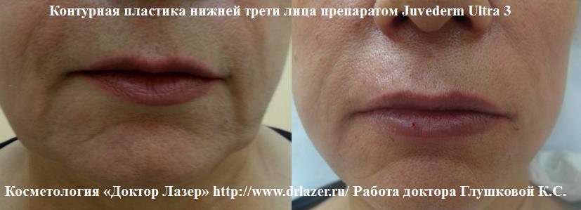  :       Juvederm Ultra 3