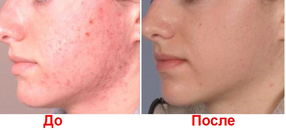 Фото лица до лечения угревой сыпи и после в косметлогиии