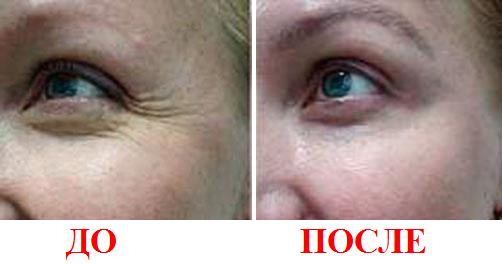 Фото до и после удаления мимических морщин вокруг глаз