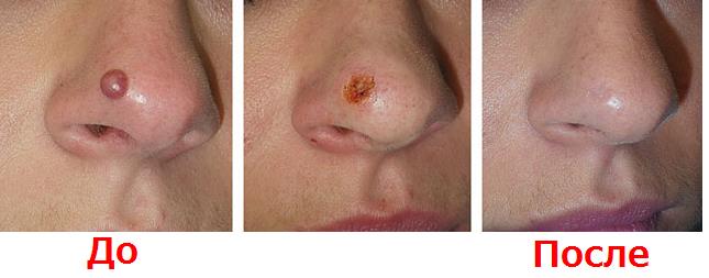 Фото до удаления образований на носу и после