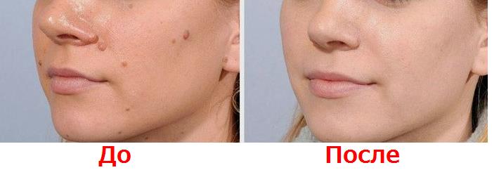 Фото до удаления новообразований на лице и после